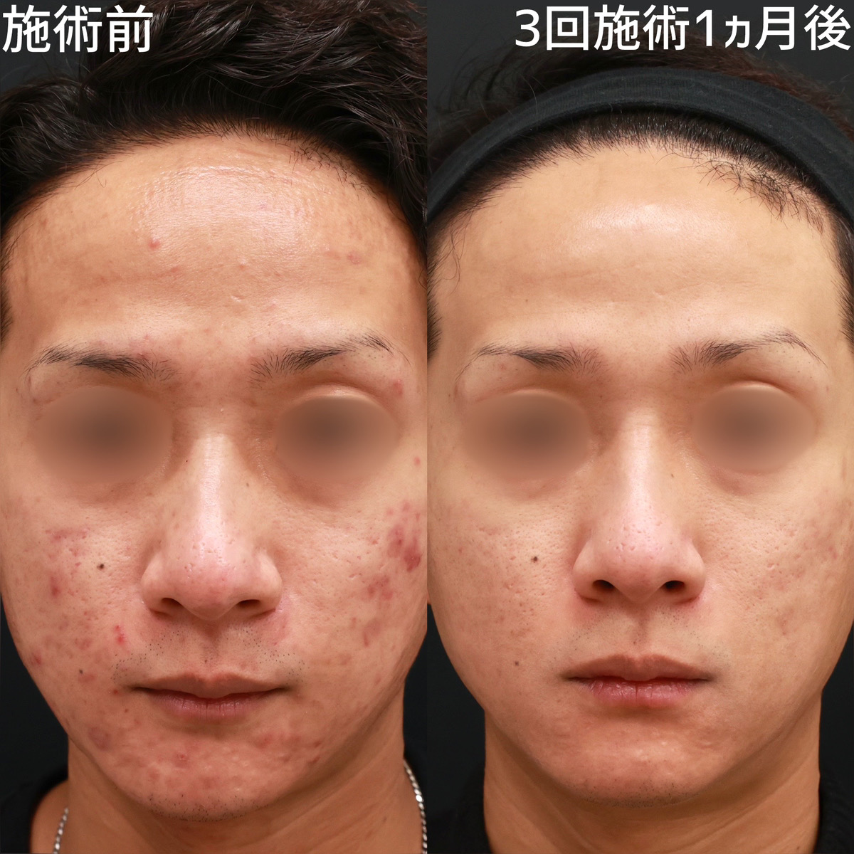 【赤ヴァンパイアフェイシャル】ニキビができにくい肌質に改善！