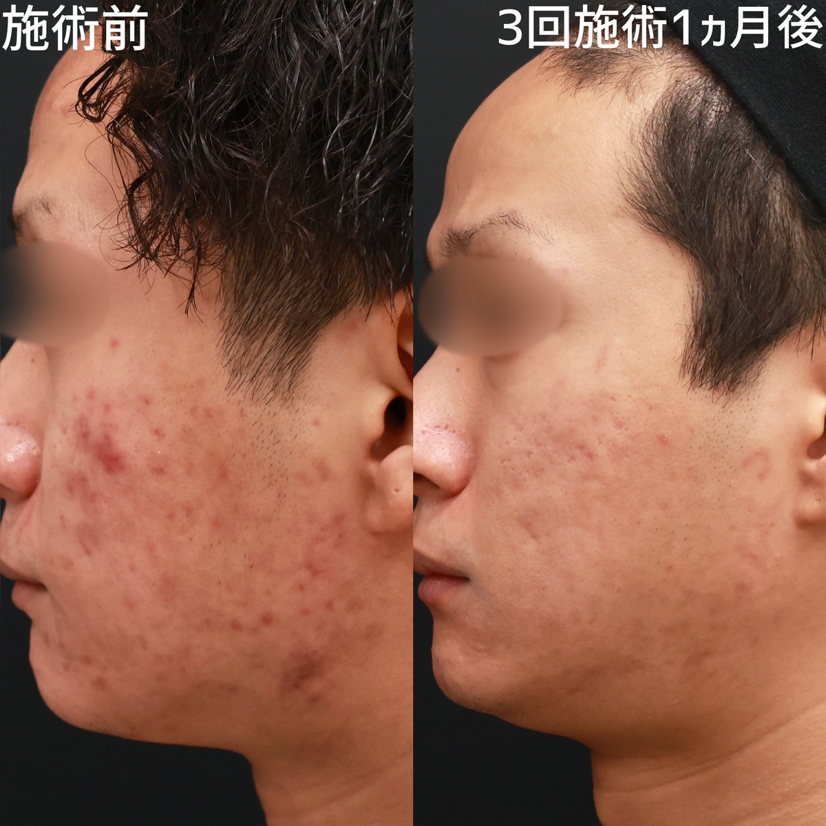ヴァンパイアフェイシャル/幹細胞エクソソーム美容液DREXエッセンスSの症例写真 施術前後 