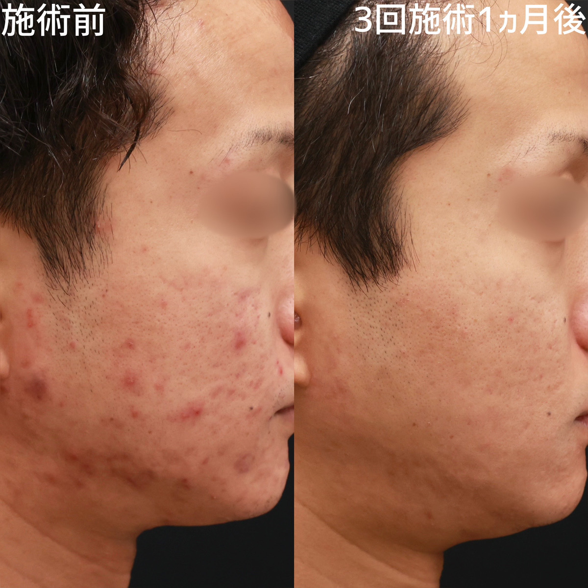 ヴァンパイアフェイシャル/幹細胞エクソソーム美容液DREXエッセンスSの症例写真 施術前後 