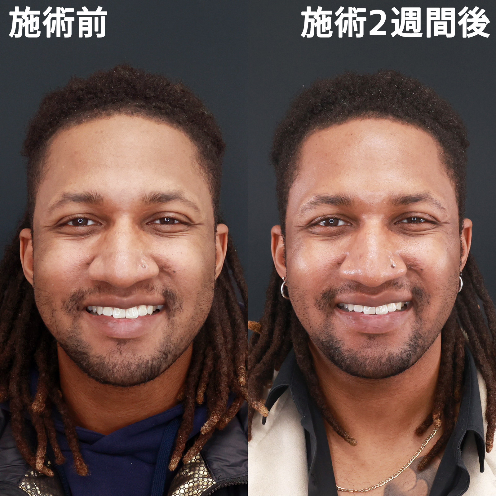 【バッカルファット除去】脂肪除去で笑った時の印象もスッキリと！