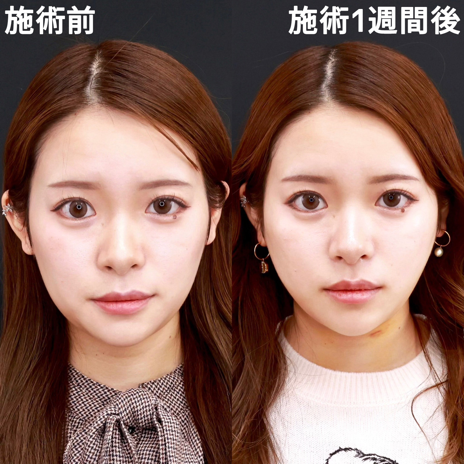 顔の脂肪吸引/TAC式 ツヤ肌コラーゲンリフト®の症例写真 施術前後