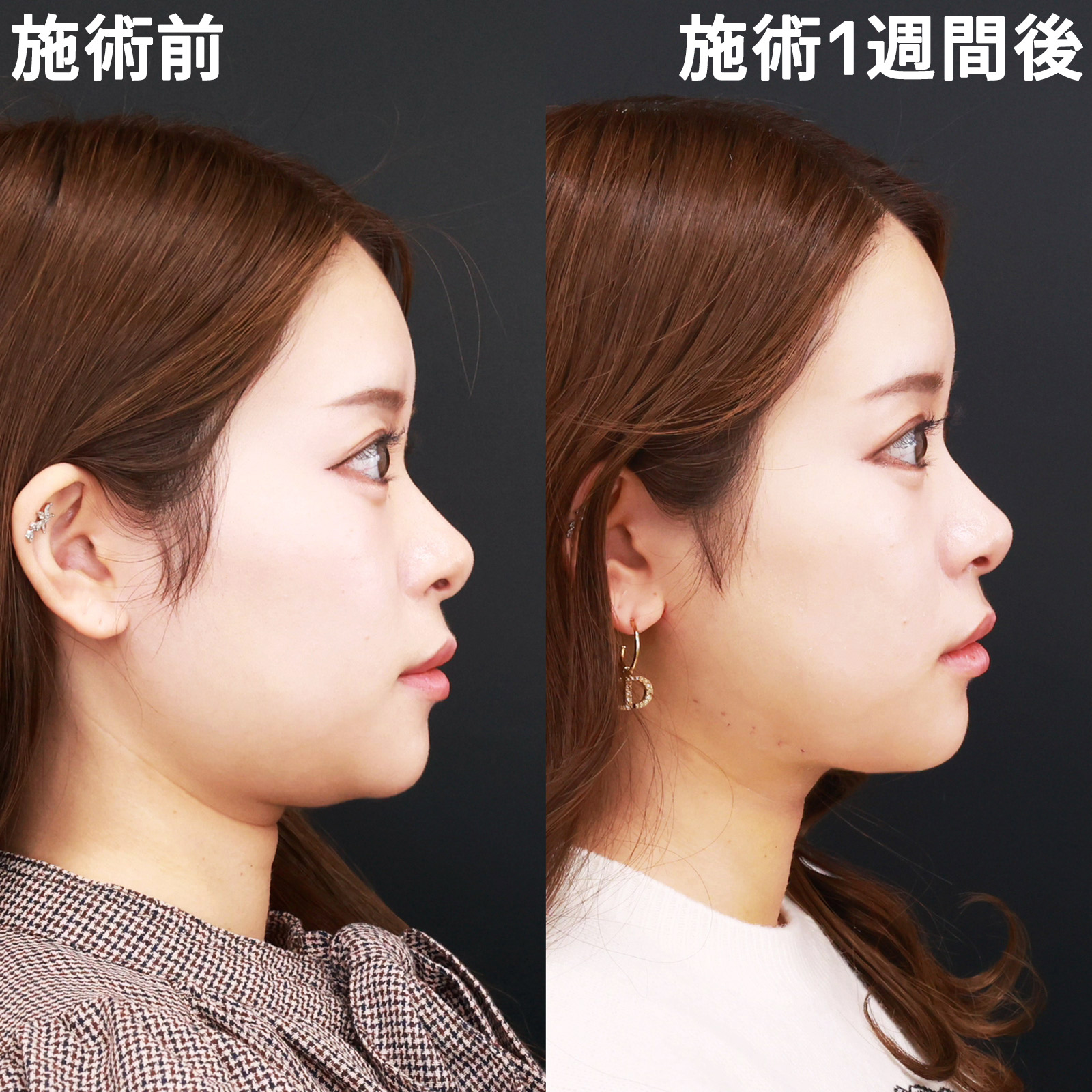 顔の脂肪吸引/TAC式 ツヤ肌コラーゲンリフト®の症例写真 施術前後
