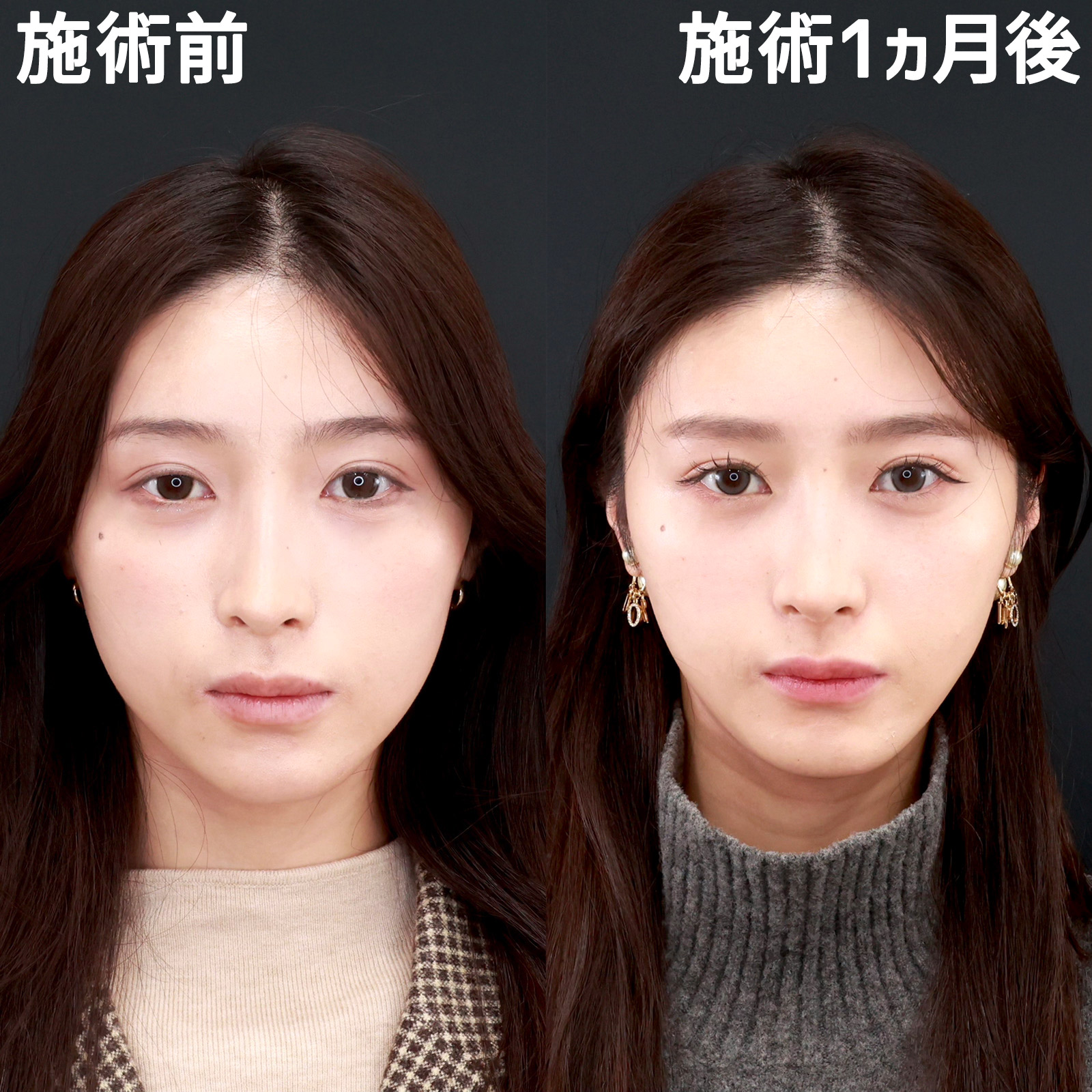 TAC式 ツヤ肌コラーゲンリフト®/エラボトックス注射/小顔整形|パーフェクトフェイスラインの症例写真 施術前後