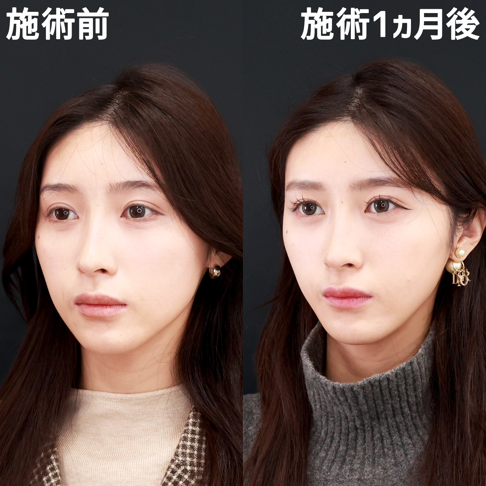 TAC式 ツヤ肌コラーゲンリフト®/エラボトックス注射/小顔整形|パーフェクトフェイスラインの症例写真 施術前後