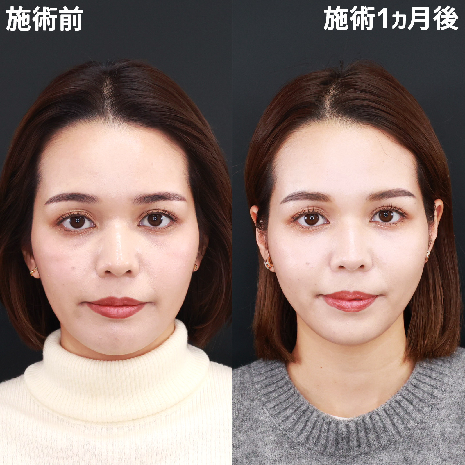 【糸リフト極＆ヒアルロン酸】ナチュラルに若返る！－５歳の小顔術