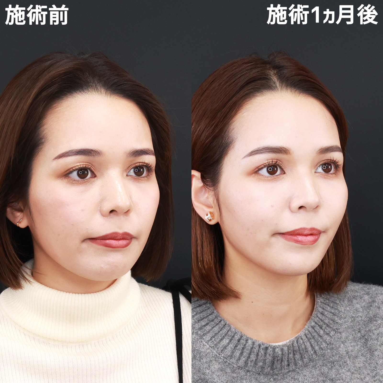 眉間のしわ取りボトックス注射/ボトックス注射：その他/TAC式 ツヤ肌コラーゲンリフト®の症例写真 施術前後 