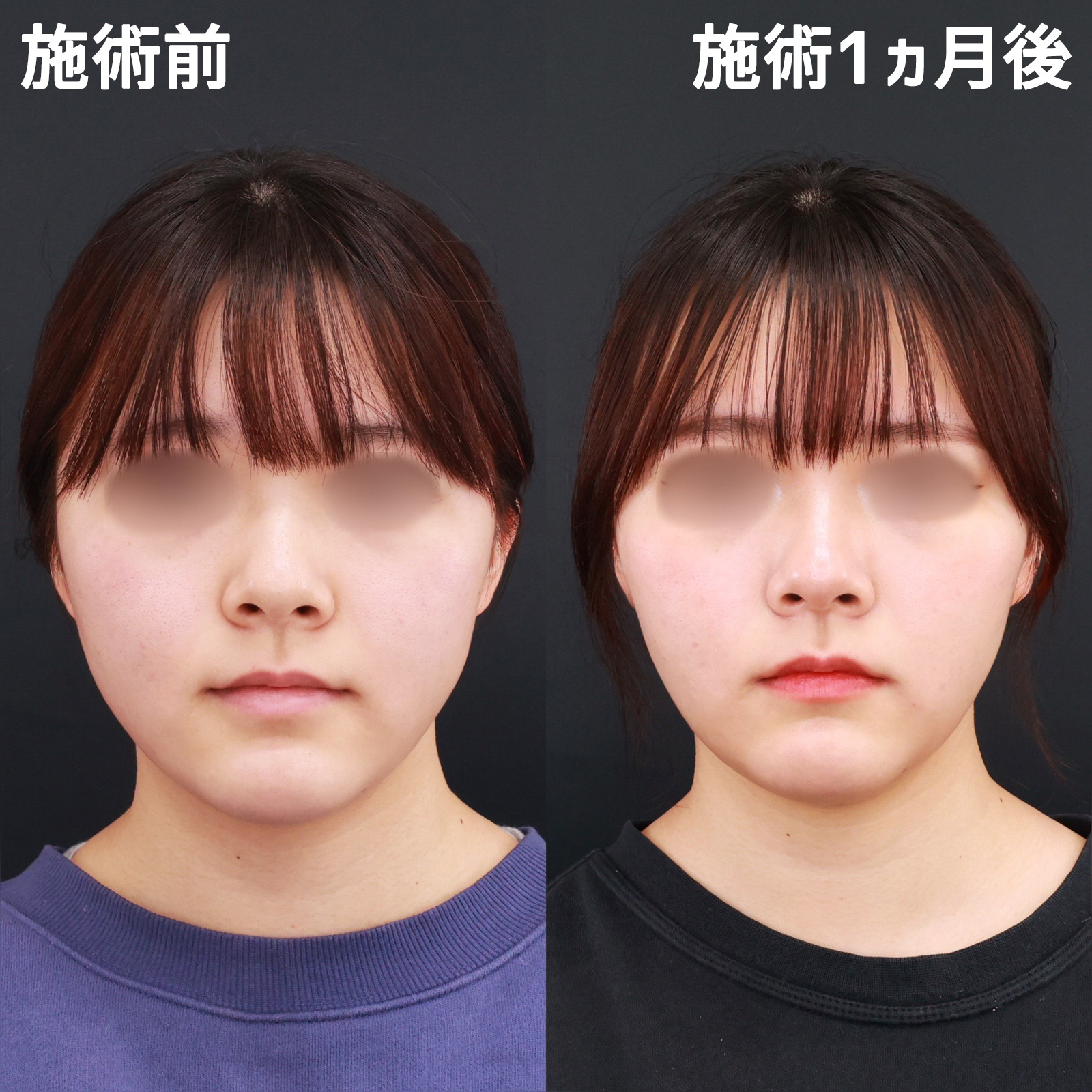 【バッカルファット除去】短いダウンタイムでお顔を一回り小さく