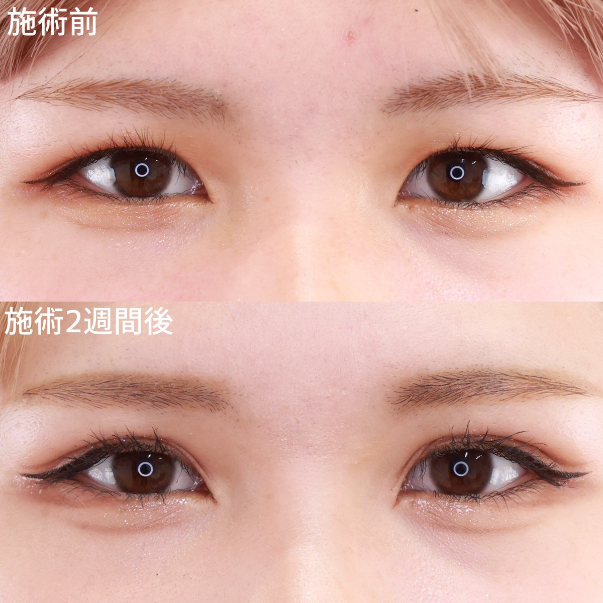 【二重埋没法】まつ毛の生え際が見える垢抜け二重