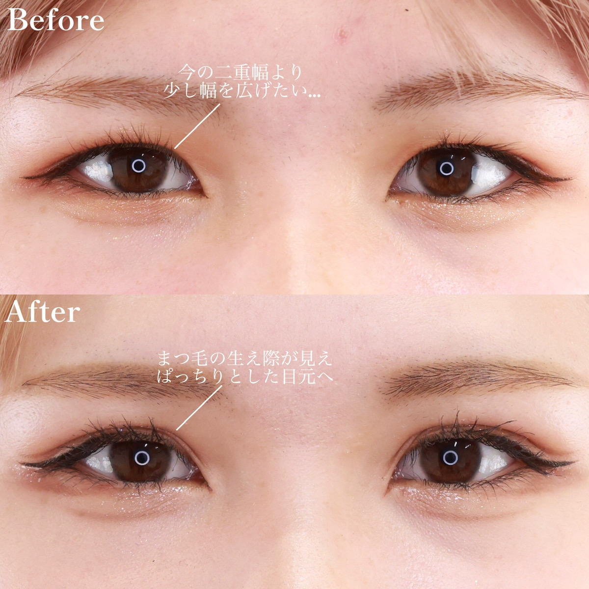 二重埋没法/目元：その他の症例写真 施術前後 