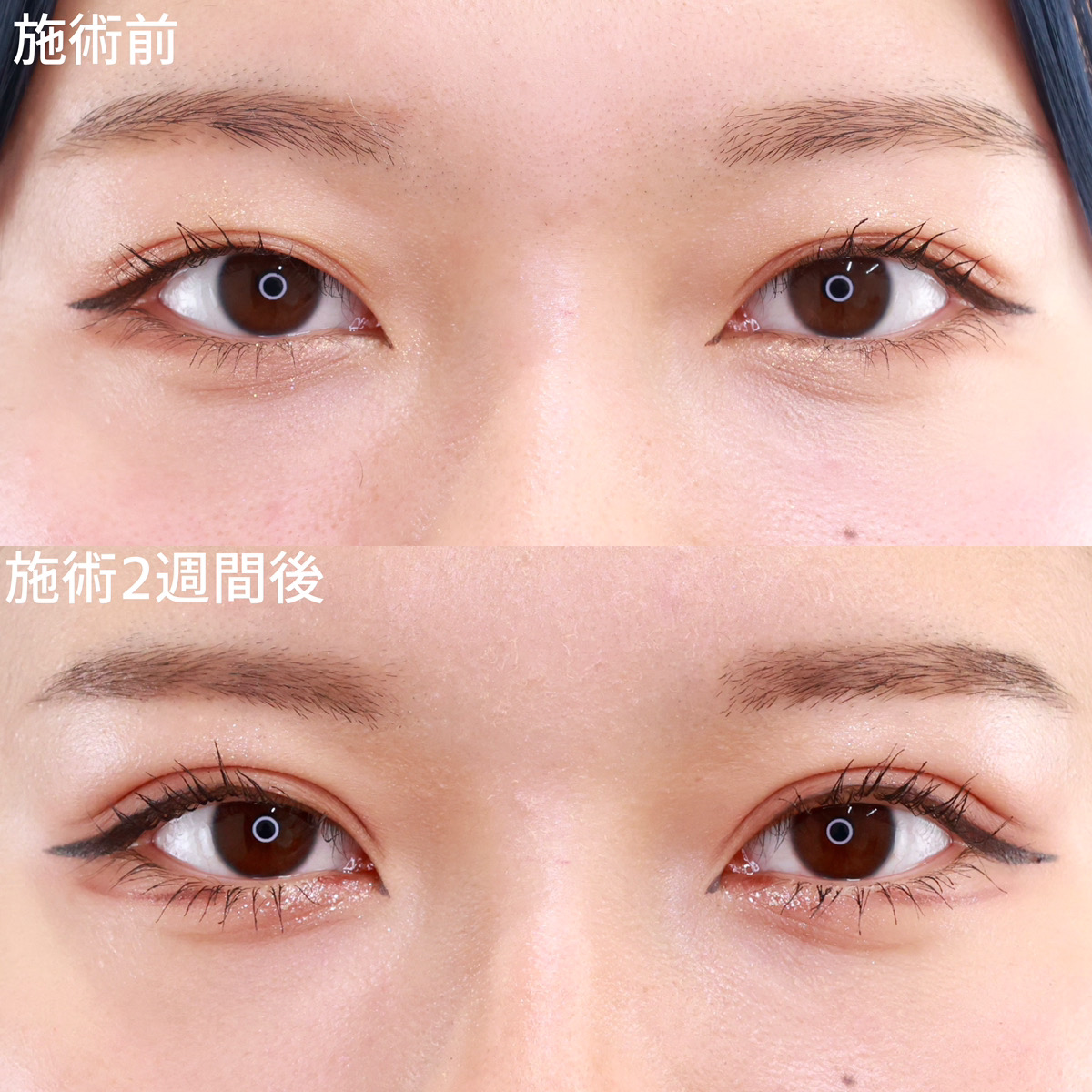 【二重埋没法】メイクの映える華やかな目元