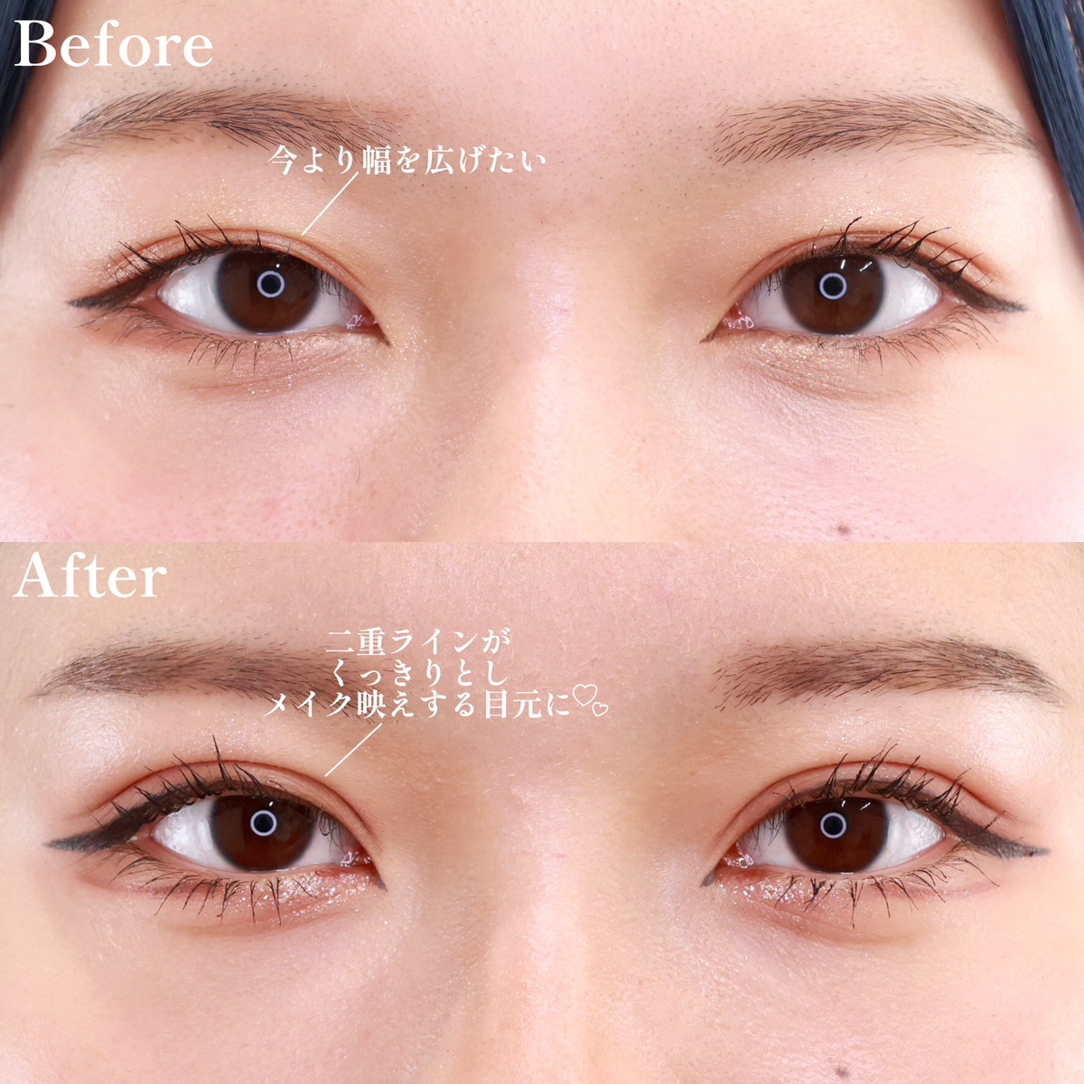 二重埋没法/目元：その他の症例写真 施術前後 