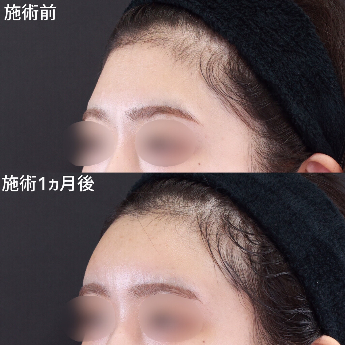 【額の脂肪注入】まるいおでこで女性らしさUP