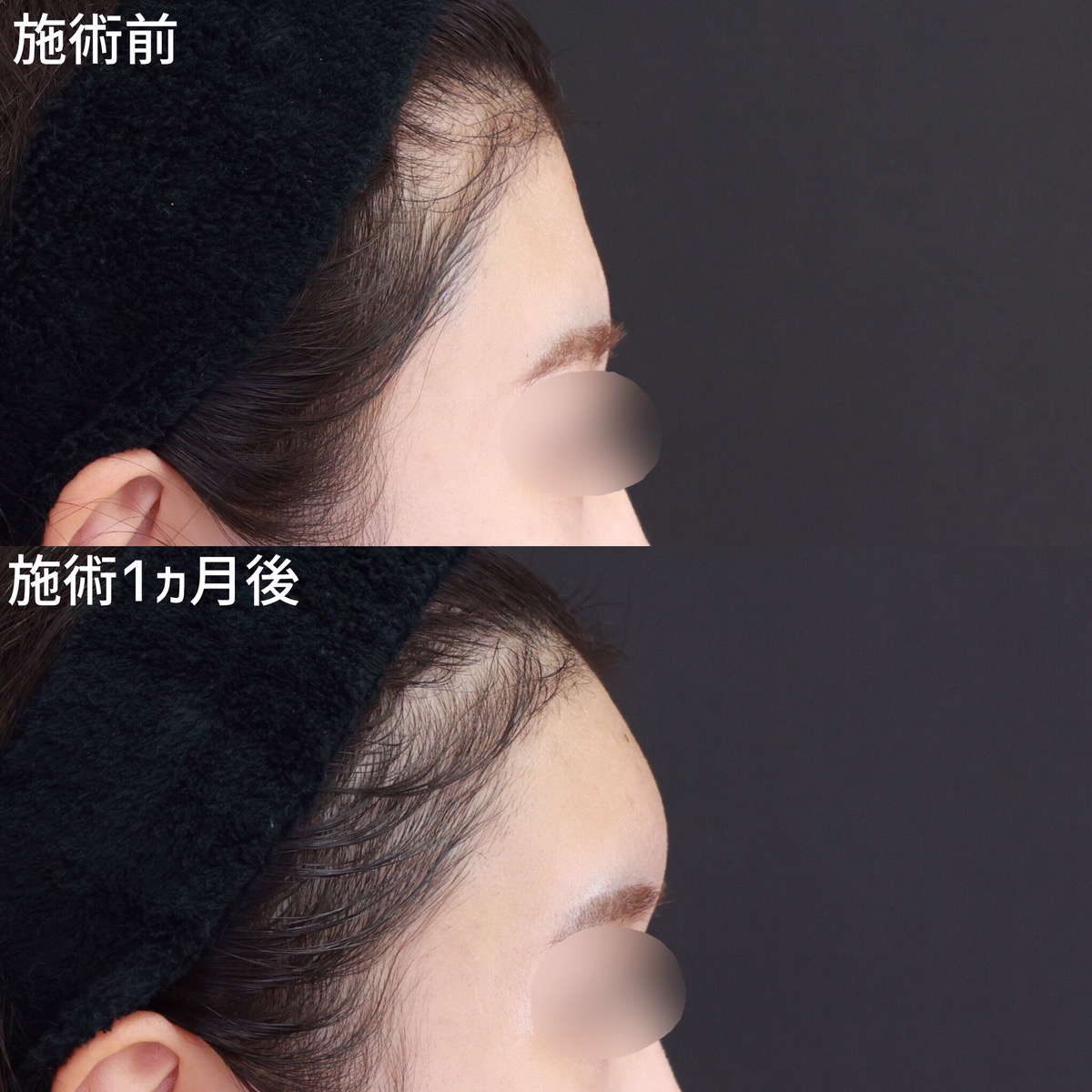 おでこの脂肪注入（オルチャンデコ形成）の症例写真 施術前後 