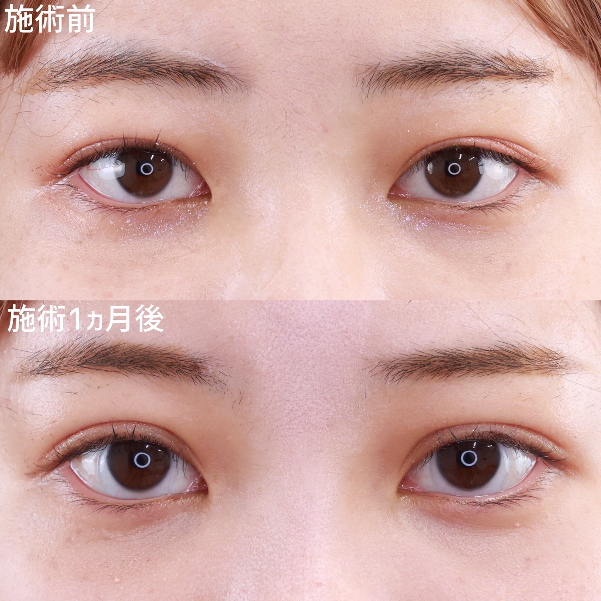 二重埋没法/目元:その他の症例写真 施術前後