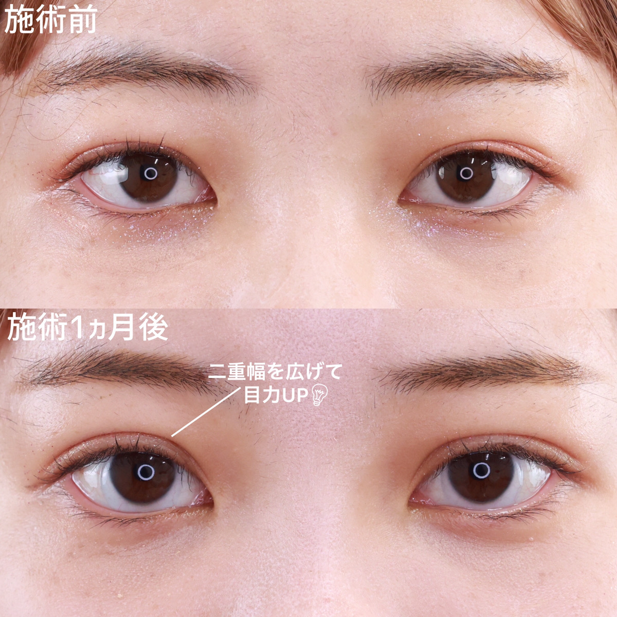 二重埋没法/目元:その他の症例写真 施術前後
