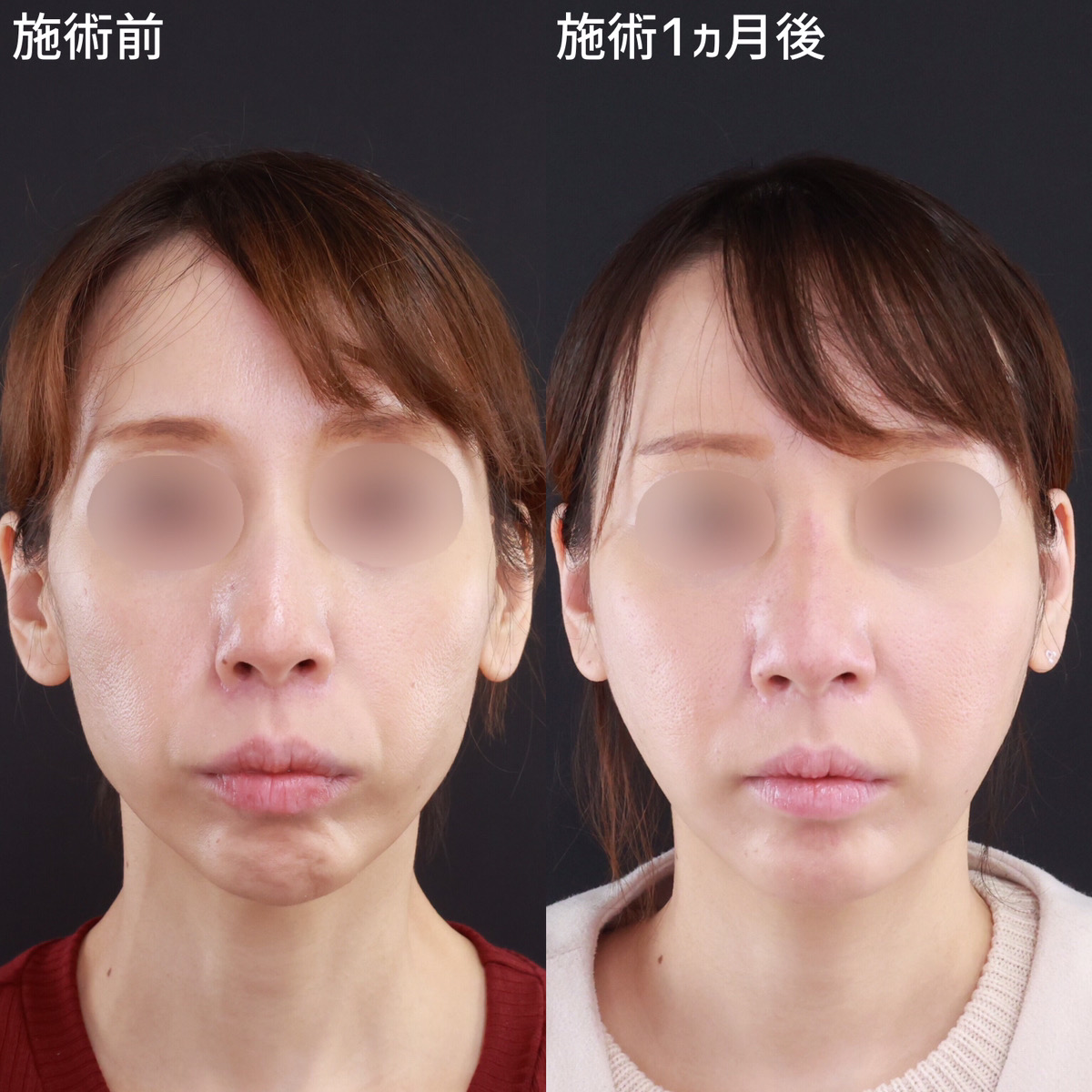 【小顔整形】脂肪除去と糸リフトの併用でバランスの良い輪郭へ