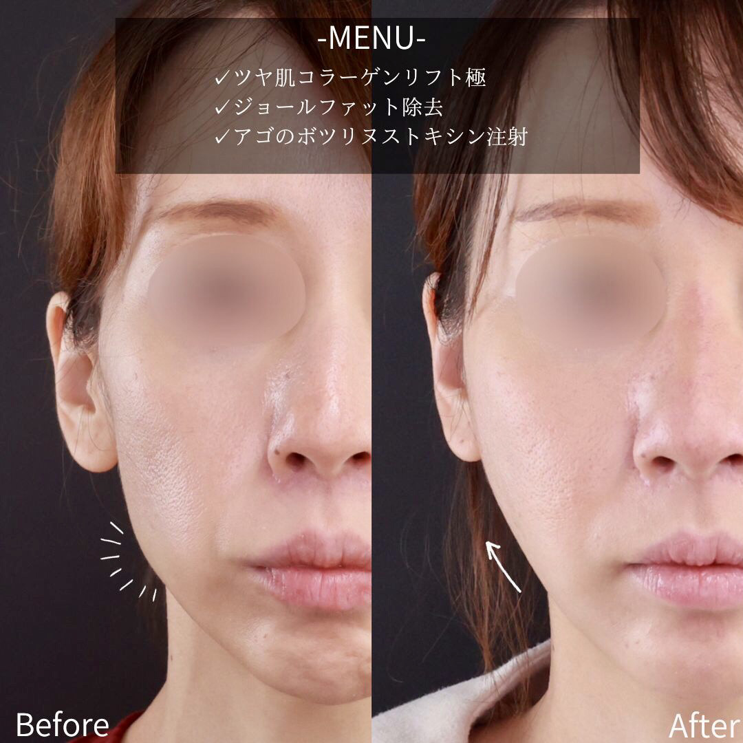 TAC式 ツヤ肌コラーゲンリフト®/ジョールファット除去/ボトックス注射：その他の症例写真 施術前後 