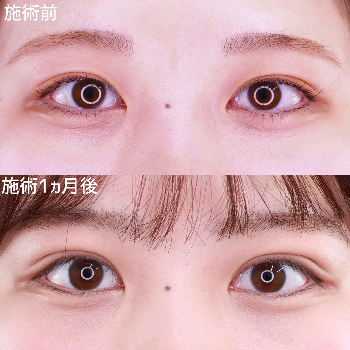 【二重埋没法】二重テープを卒業！今よりもっと可愛い目元に！
