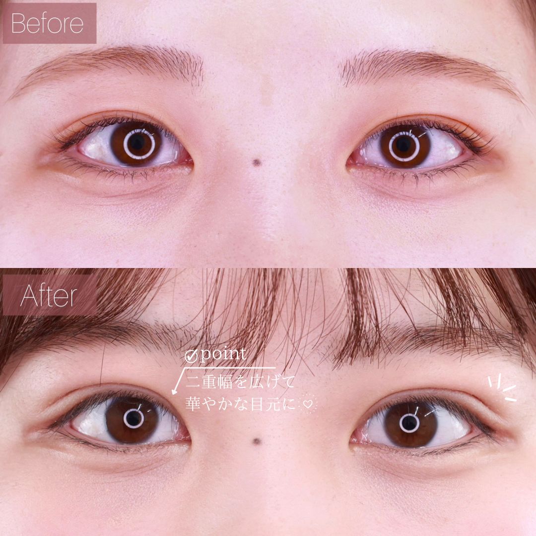 二重埋没法/目元：その他の症例写真 施術前後 