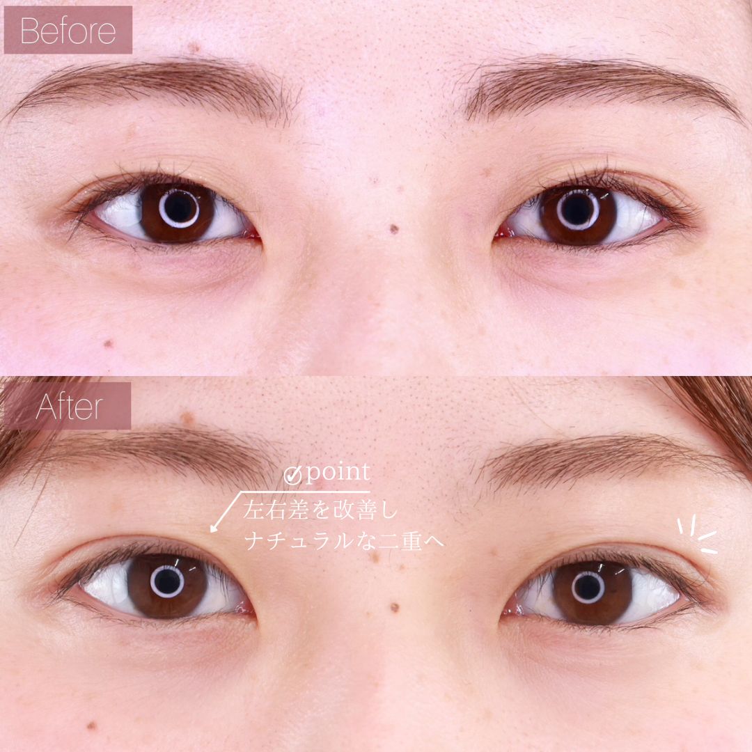 二重埋没法/目元：その他の症例写真 施術前後 