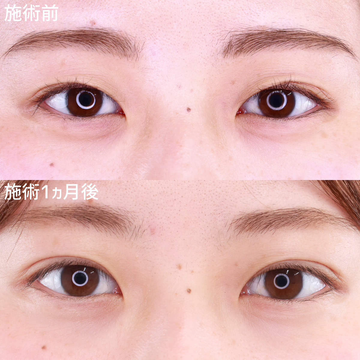 【二重埋没法】ナチュラルで自分に合った二重に