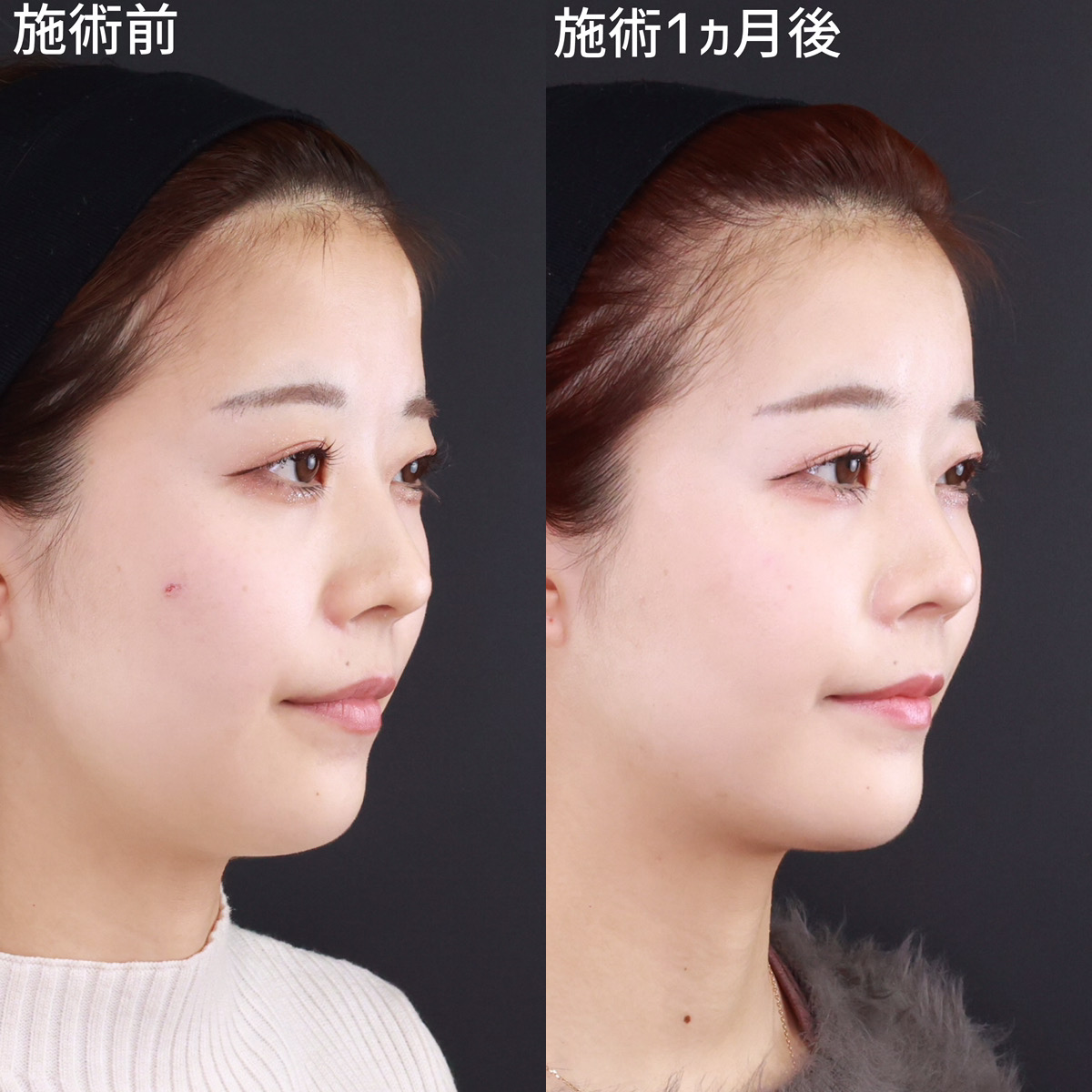 顔の脂肪注入(コンデンスリッチフェイス)/おでこの脂肪注入（オルチャンデコ形成）/下眼瞼脱脂術（目の下のたるみ取り・目の下の脂肪ふくらみ取り）の症例写真 施術前後 