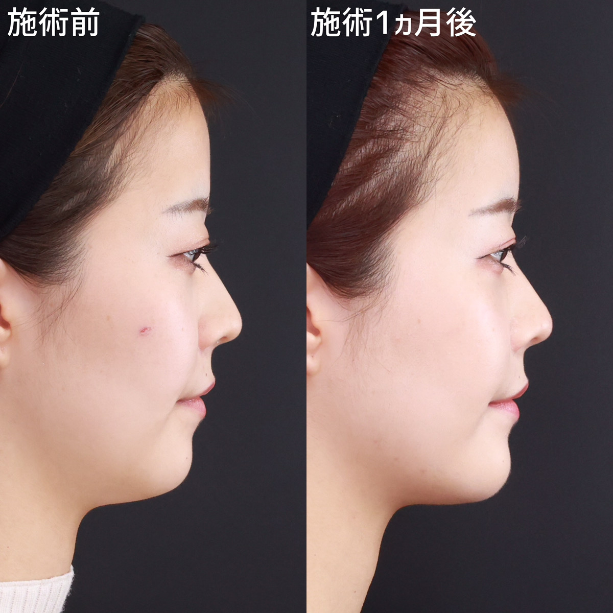 【額の脂肪注入】ゴツゴツとした印象を改善！女性らしいフォルムへ