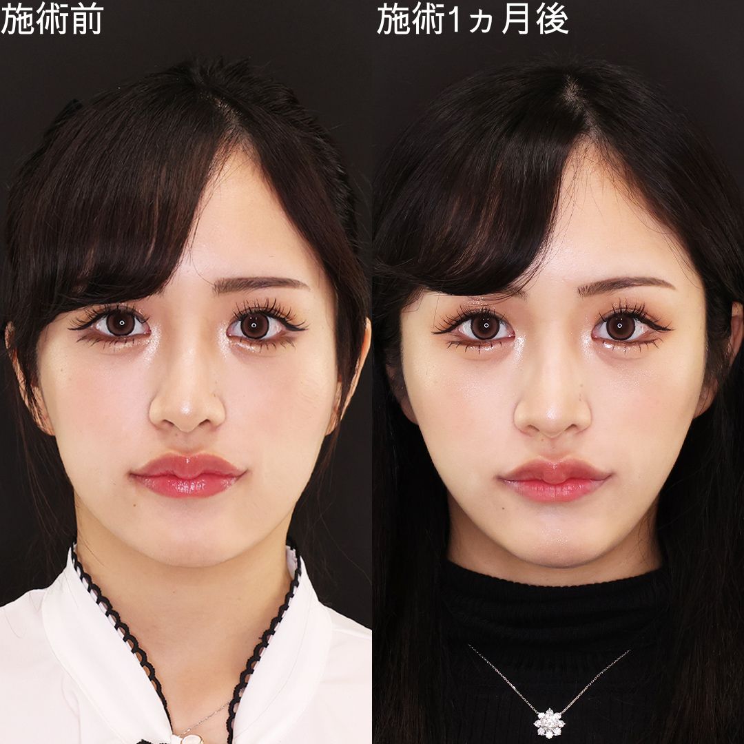 頬コケ・弛みを同時に改善！女優級小顔術！