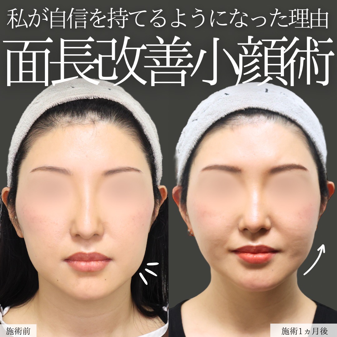 TAC式 ツヤ肌コラーゲンリフト®/ジョールファット除去/バッカルファット除去の症例写真 施術前後 