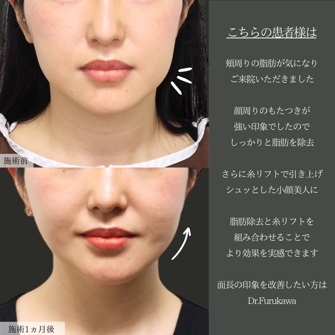 TAC式 ツヤ肌コラーゲンリフト®/ジョールファット除去/バッカルファット除去の症例写真 施術前後 