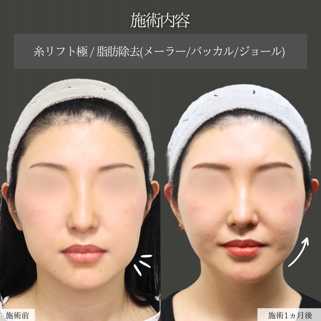 TAC式 ツヤ肌コラーゲンリフト®/ジョールファット除去/バッカルファット除去の症例写真 施術前後 