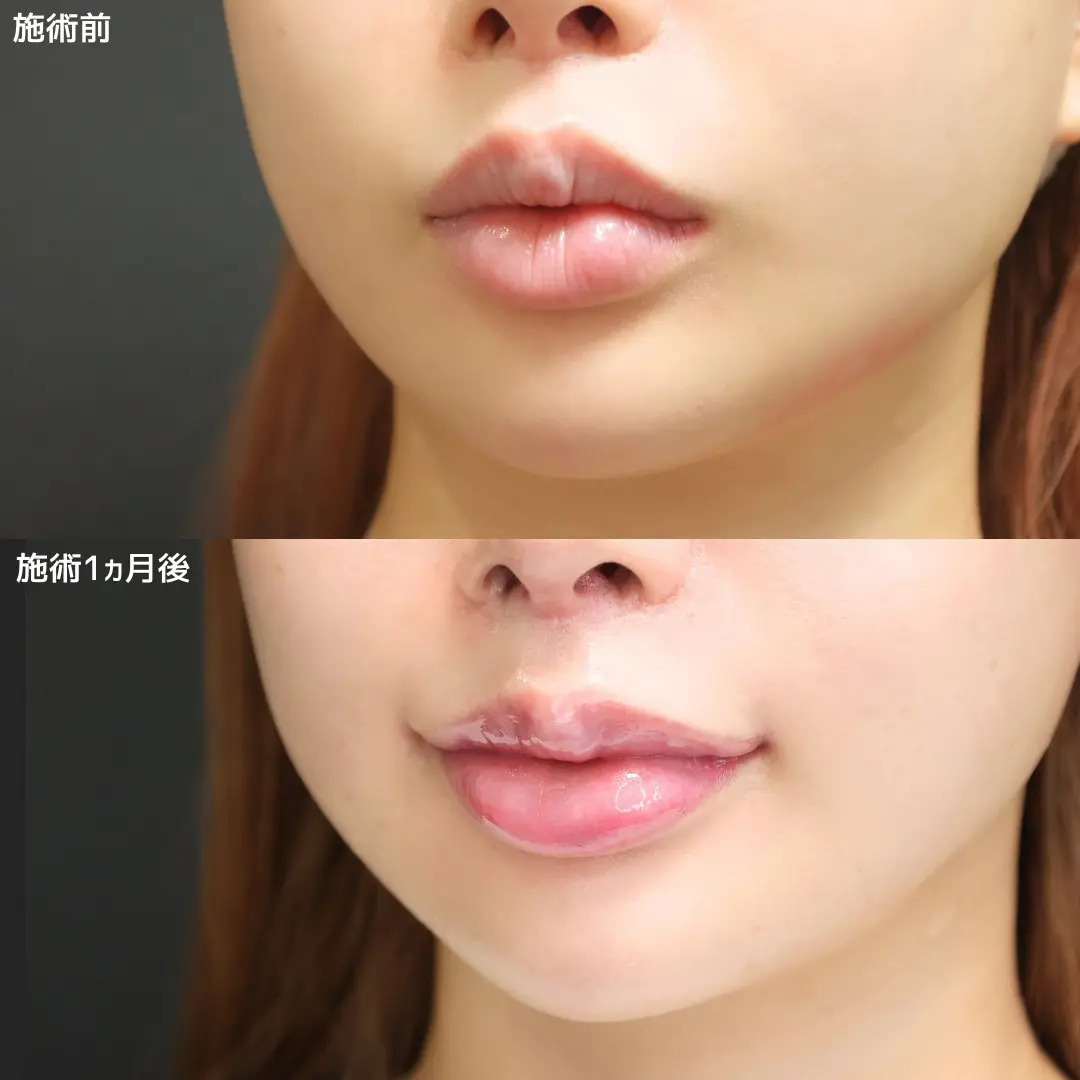 口角挙上・リフト（マイクロ切開法・内側法/口内法）の症例写真 施術前後 