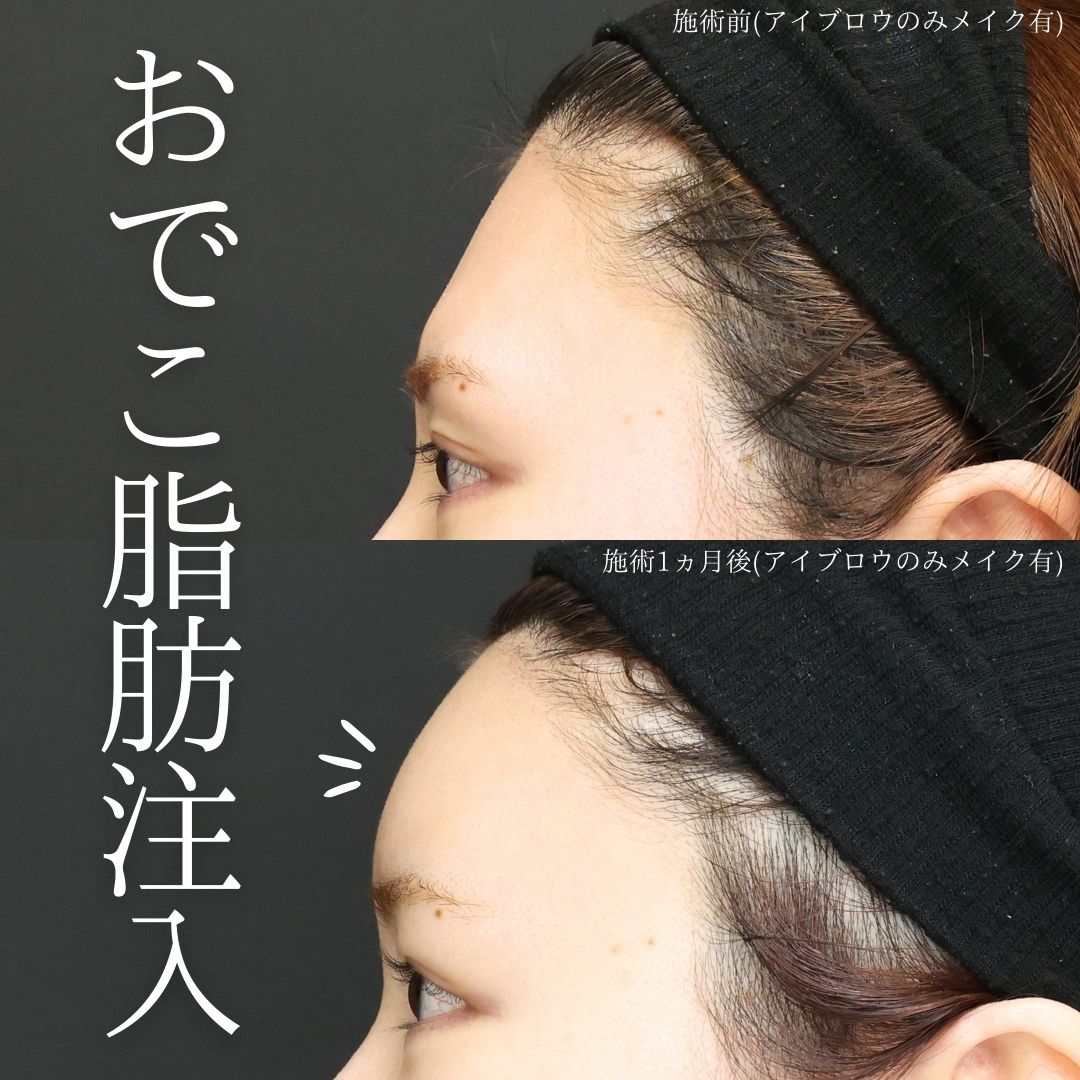 おでこの脂肪注入（オルチャンデコ形成）/おでこボトックス注射の症例写真 施術前後 