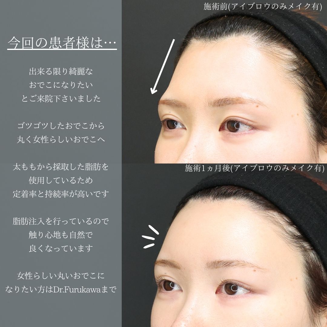 おでこの脂肪注入（オルチャンデコ形成）/おでこボトックス注射の症例写真 施術前後 