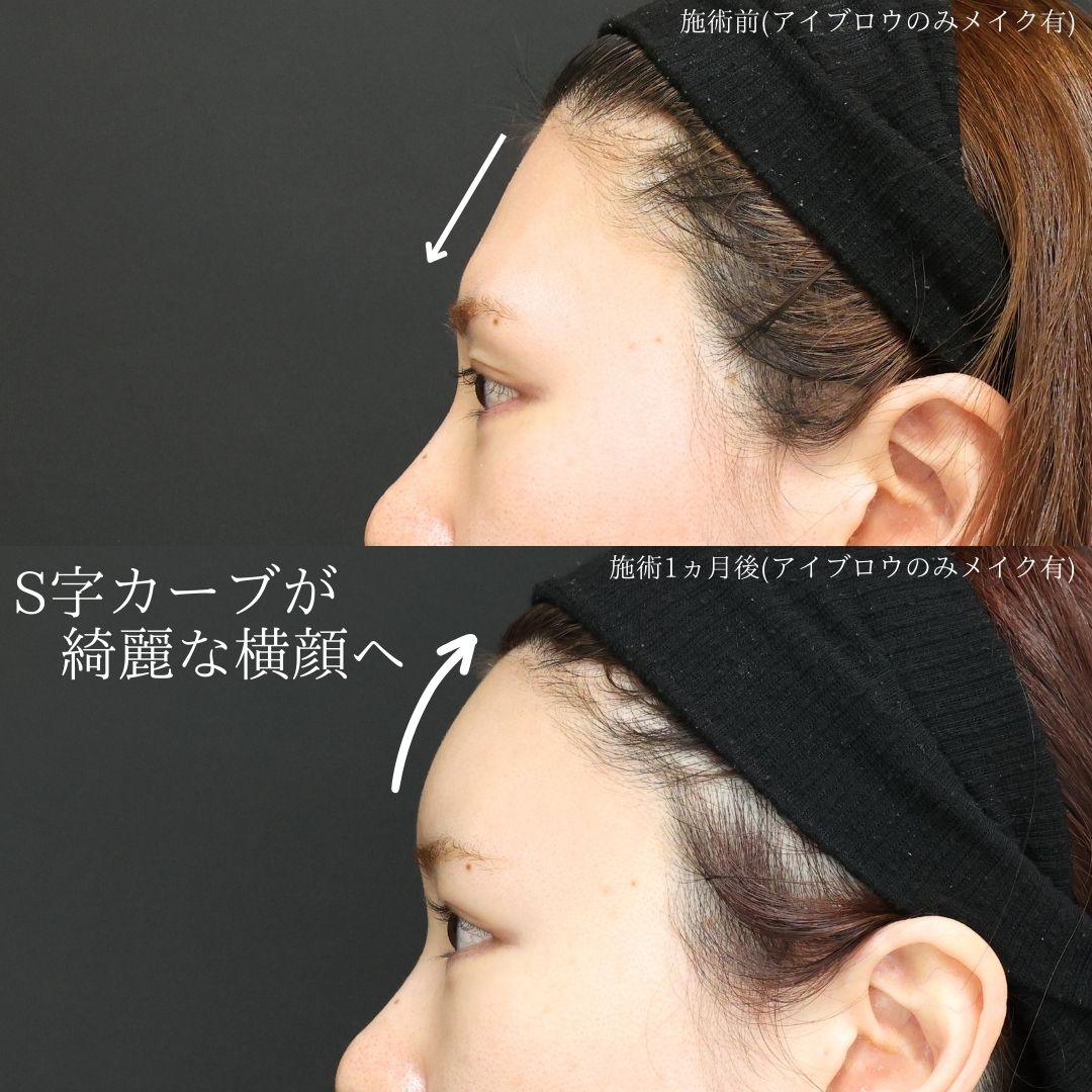 おでこの脂肪注入（オルチャンデコ形成）/おでこボトックス注射の症例写真 施術前後 