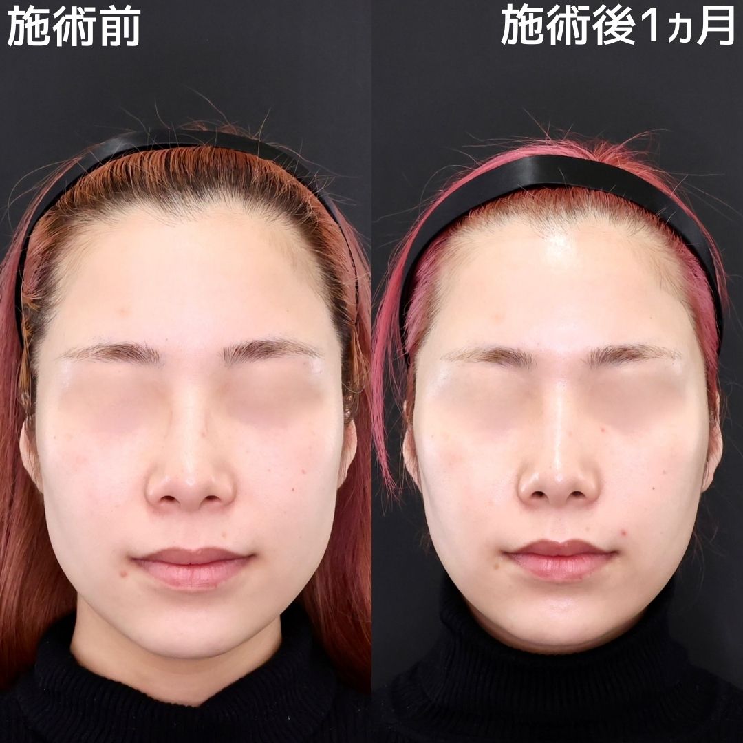 【糸リフト×ボトックス】ダウンタイム最小限の小顔術