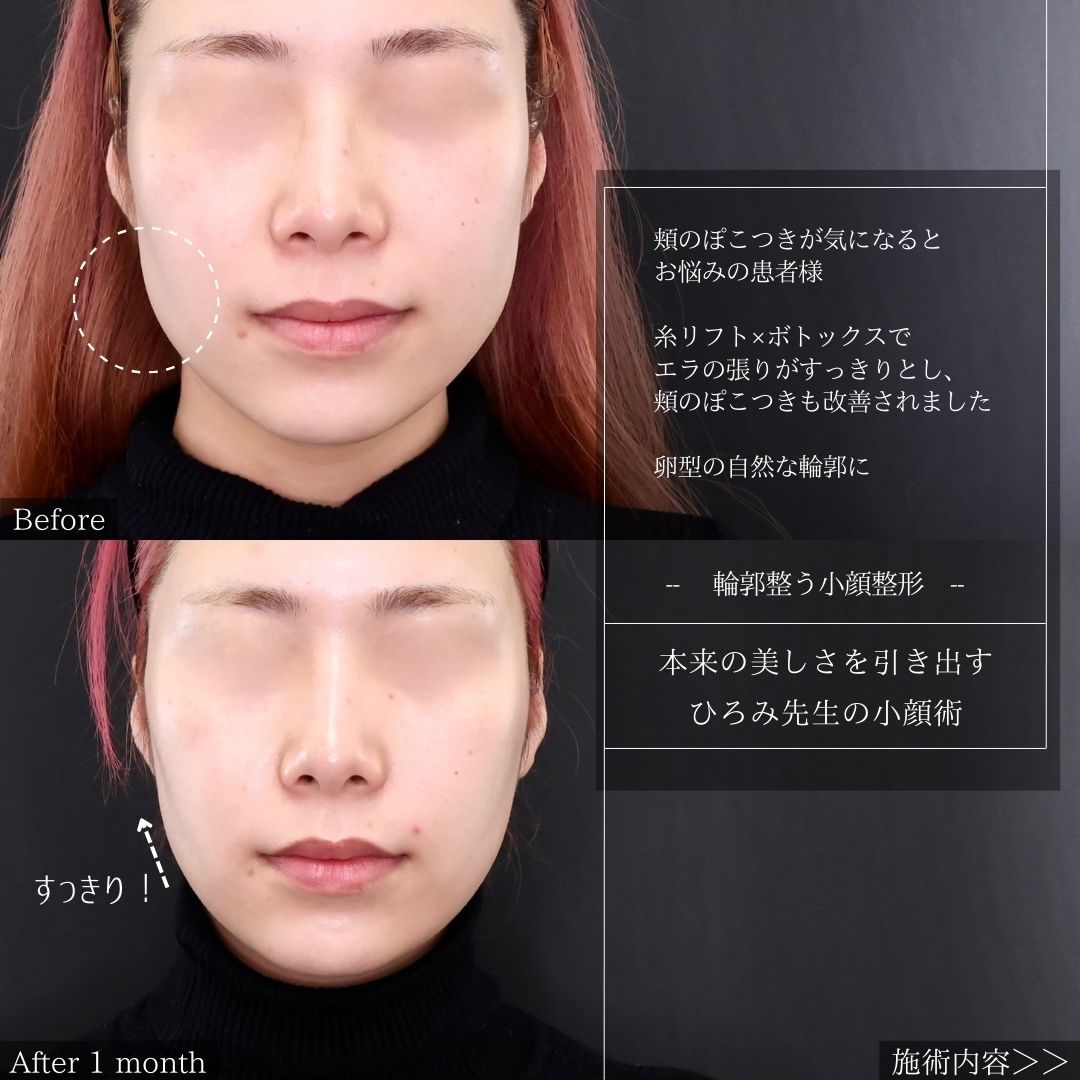 TAC式 ツヤ肌コラーゲンリフト®/エラボトックス注射の症例写真 施術前後 