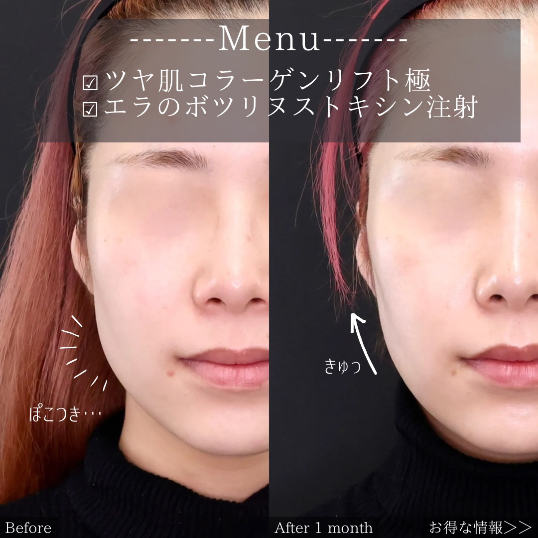 TAC式 ツヤ肌コラーゲンリフト®/エラボトックス注射の症例写真 施術前後 