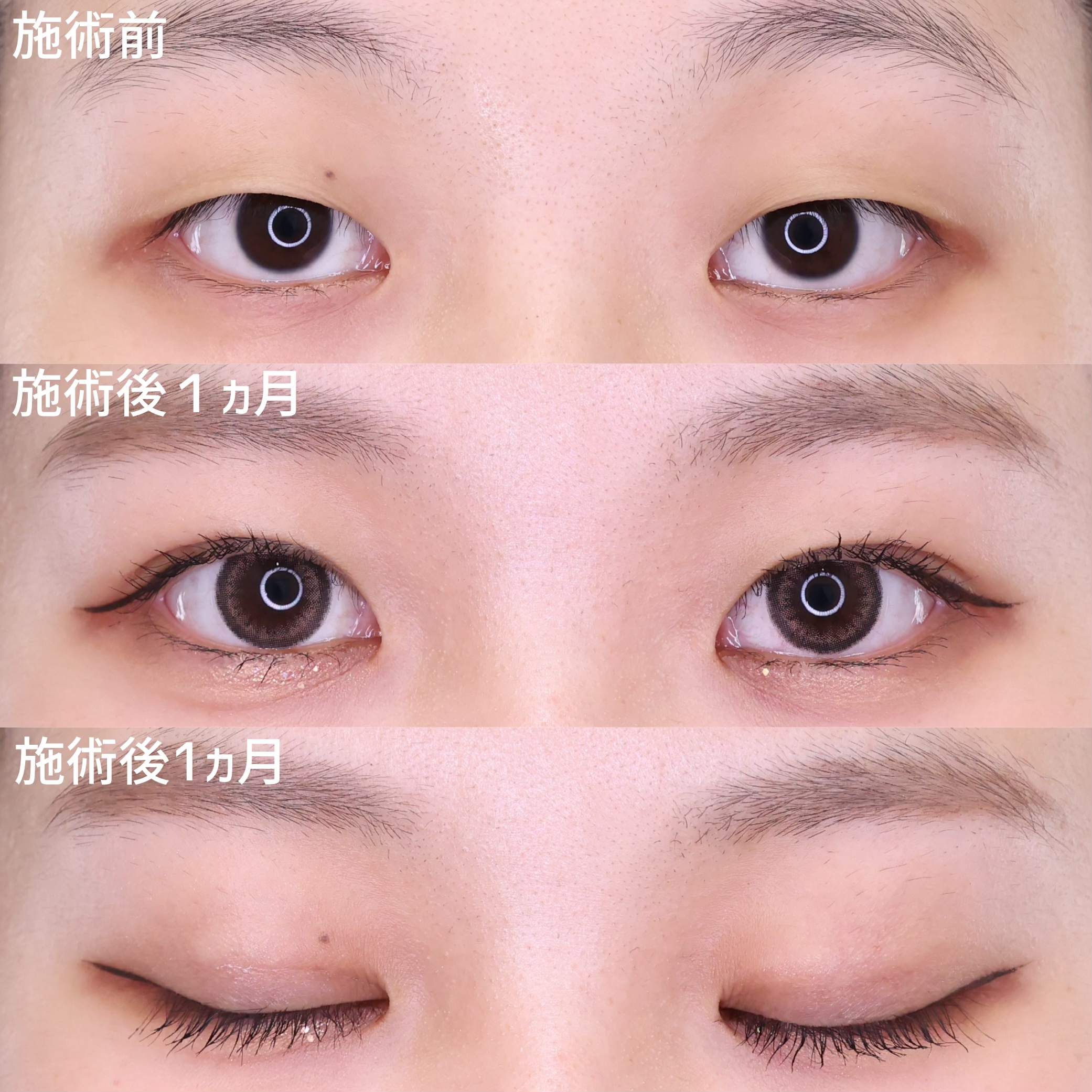 二重埋没法の症例写真 施術前後 