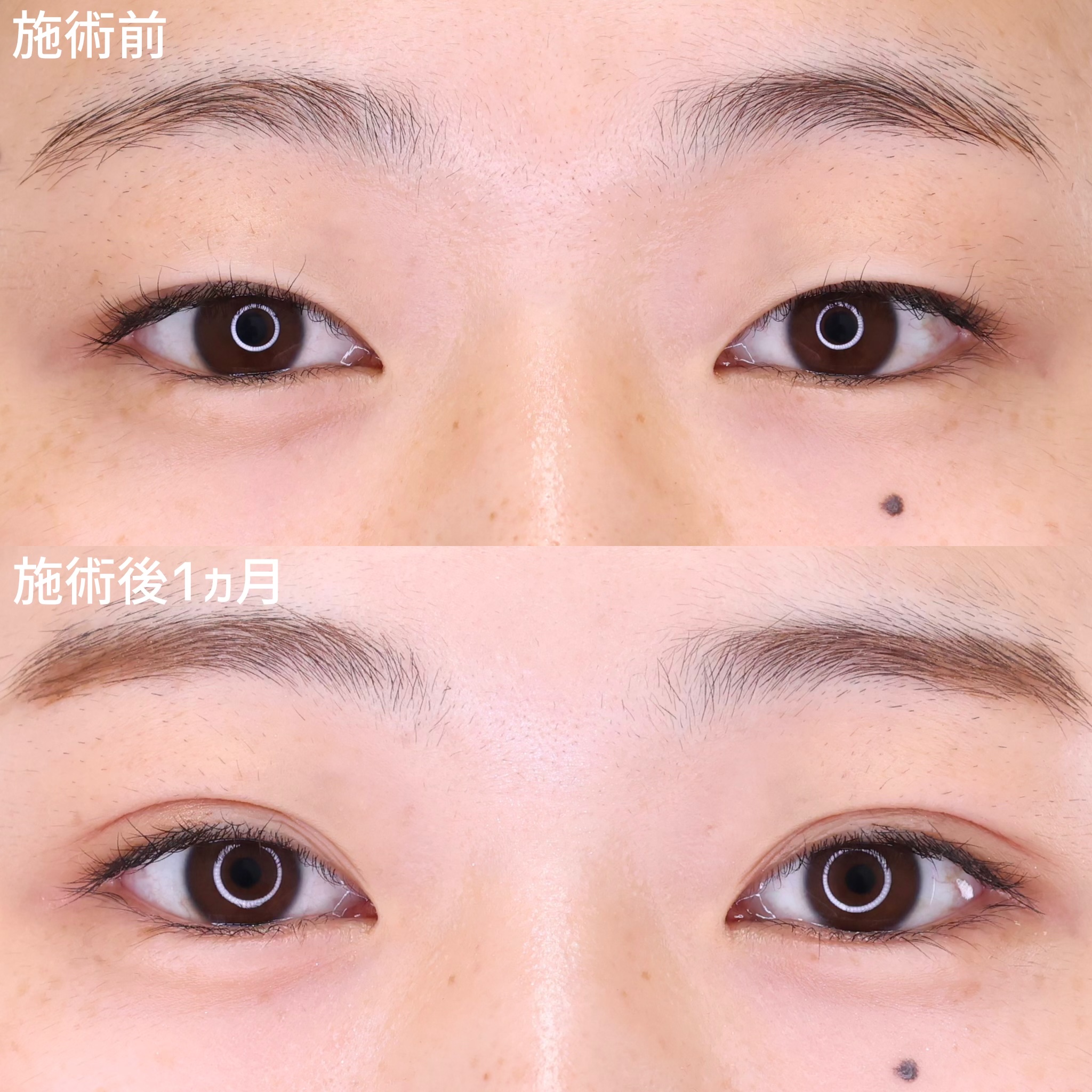 【二重埋没法】自然に目元の印象を変える！二重術