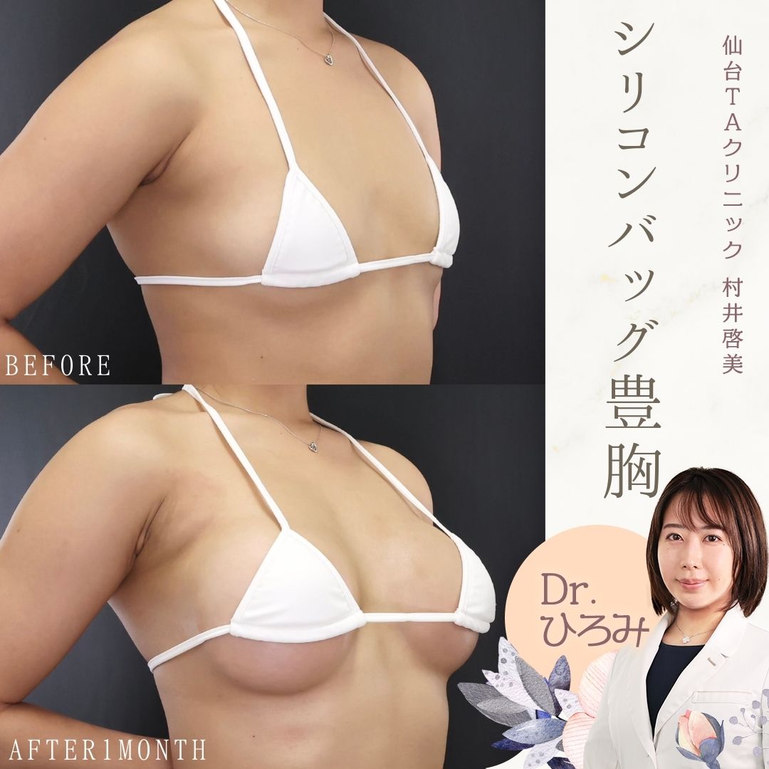 シリコンバッグ豊胸（人工乳腺バッグ）の症例写真 施術前後 