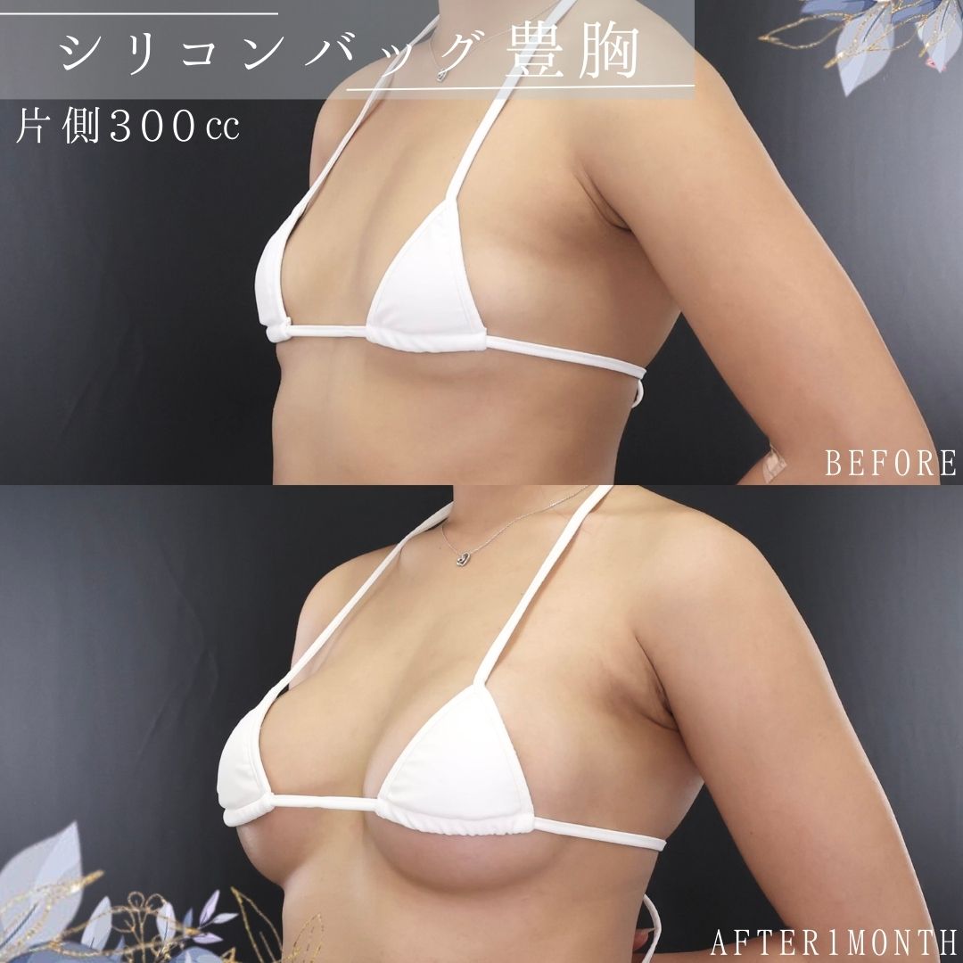 シリコンバッグ豊胸（人工乳腺バッグ）の症例写真 施術前後 