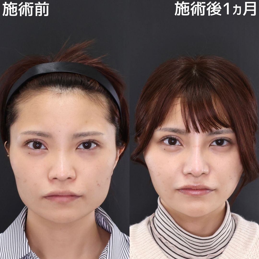 【糸リフト×ボトックス】エラのハリ改善で整った輪郭に