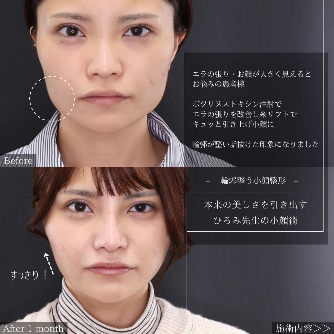 TAC式 ツヤ肌コラーゲンリフト®/ジョールファット除去/エラボトックス注射の症例写真 施術前後 