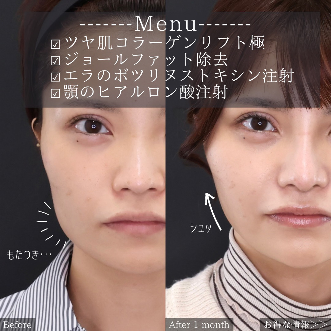 TAC式 ツヤ肌コラーゲンリフト®/ジョールファット除去/エラボトックス注射の症例写真 施術前後 