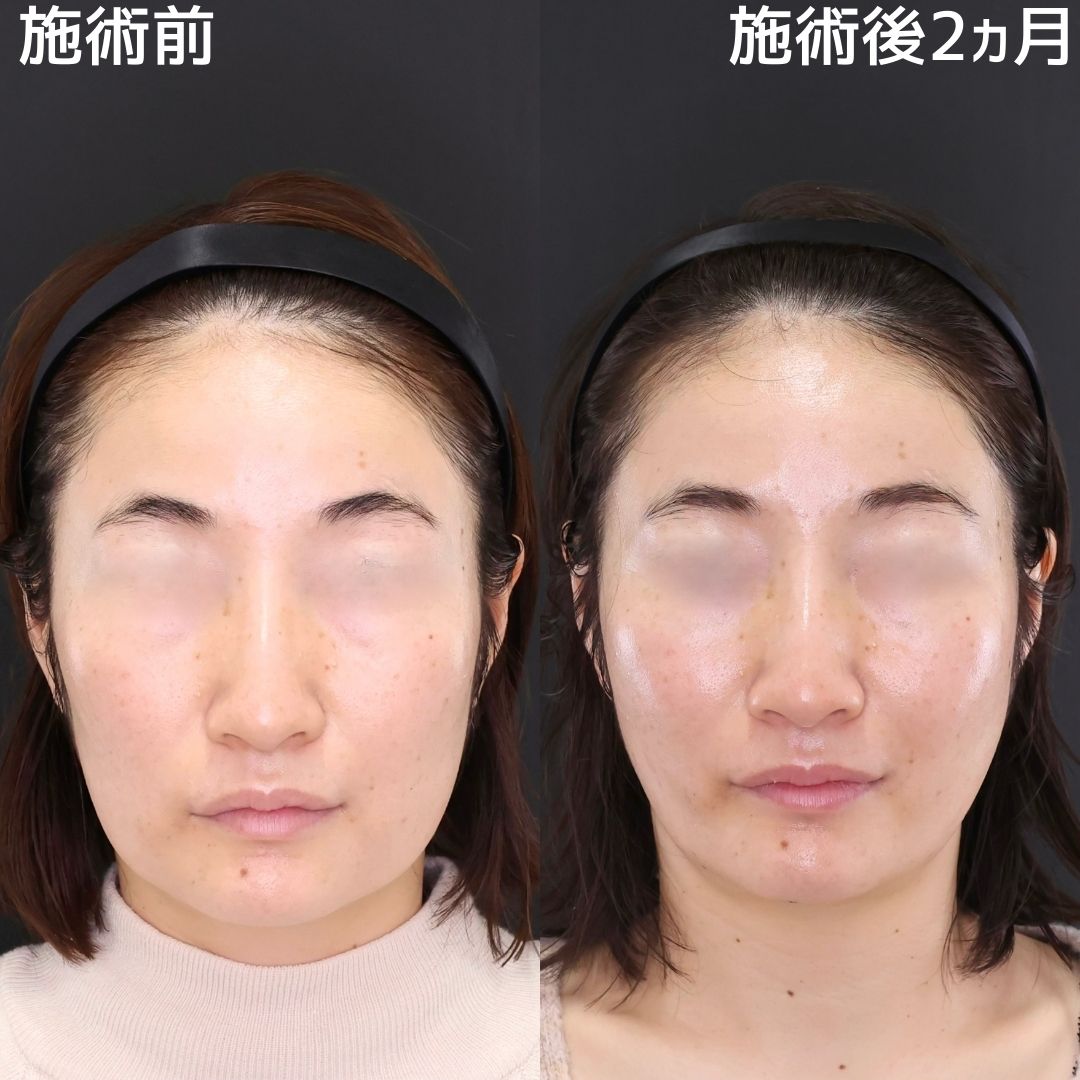 【糸リフト×脂肪除去】脱ベース型！憧れの卵型の輪郭へ