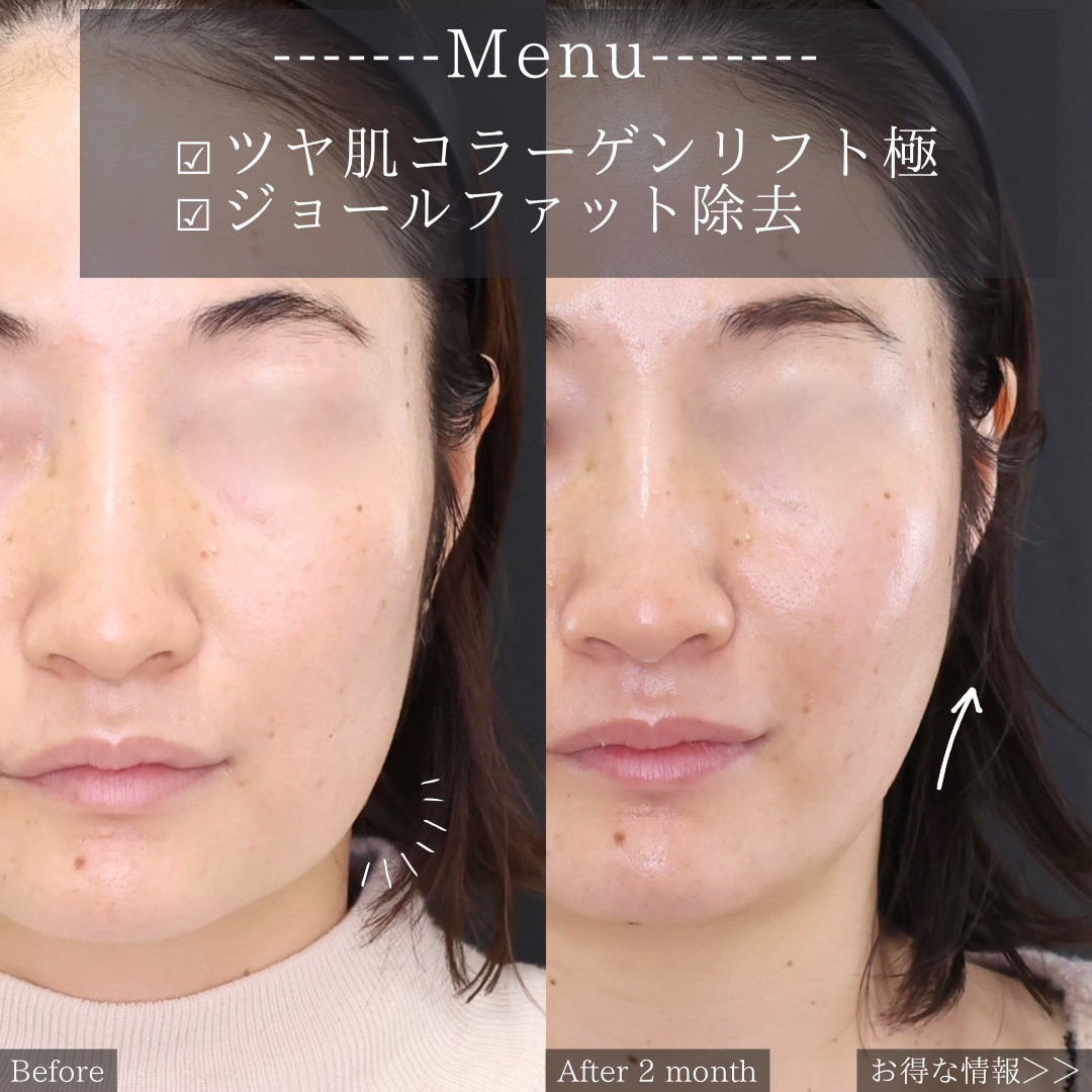 TAC式 ツヤ肌コラーゲンリフト®/ジョールファット除去の症例写真 施術前後 