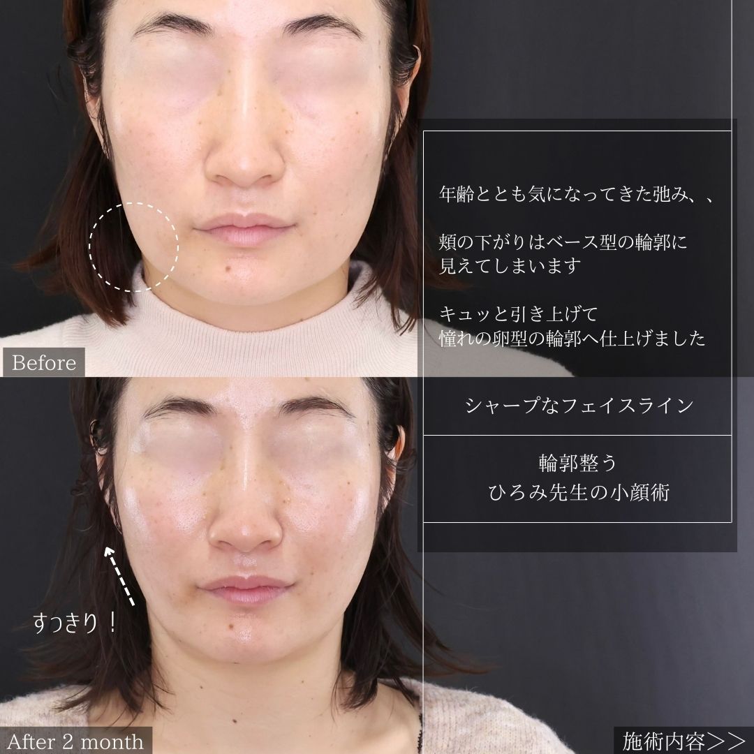 TAC式 ツヤ肌コラーゲンリフト®/ジョールファット除去の症例写真 施術前後 