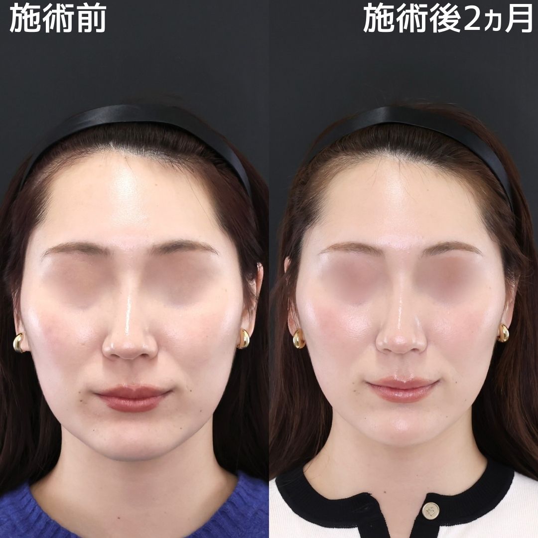 TAC式 ツヤ肌コラーゲンリフト®/Lラインファット除去(エラ下脂肪除去)/エラボトックス注射の症例写真 施術前後