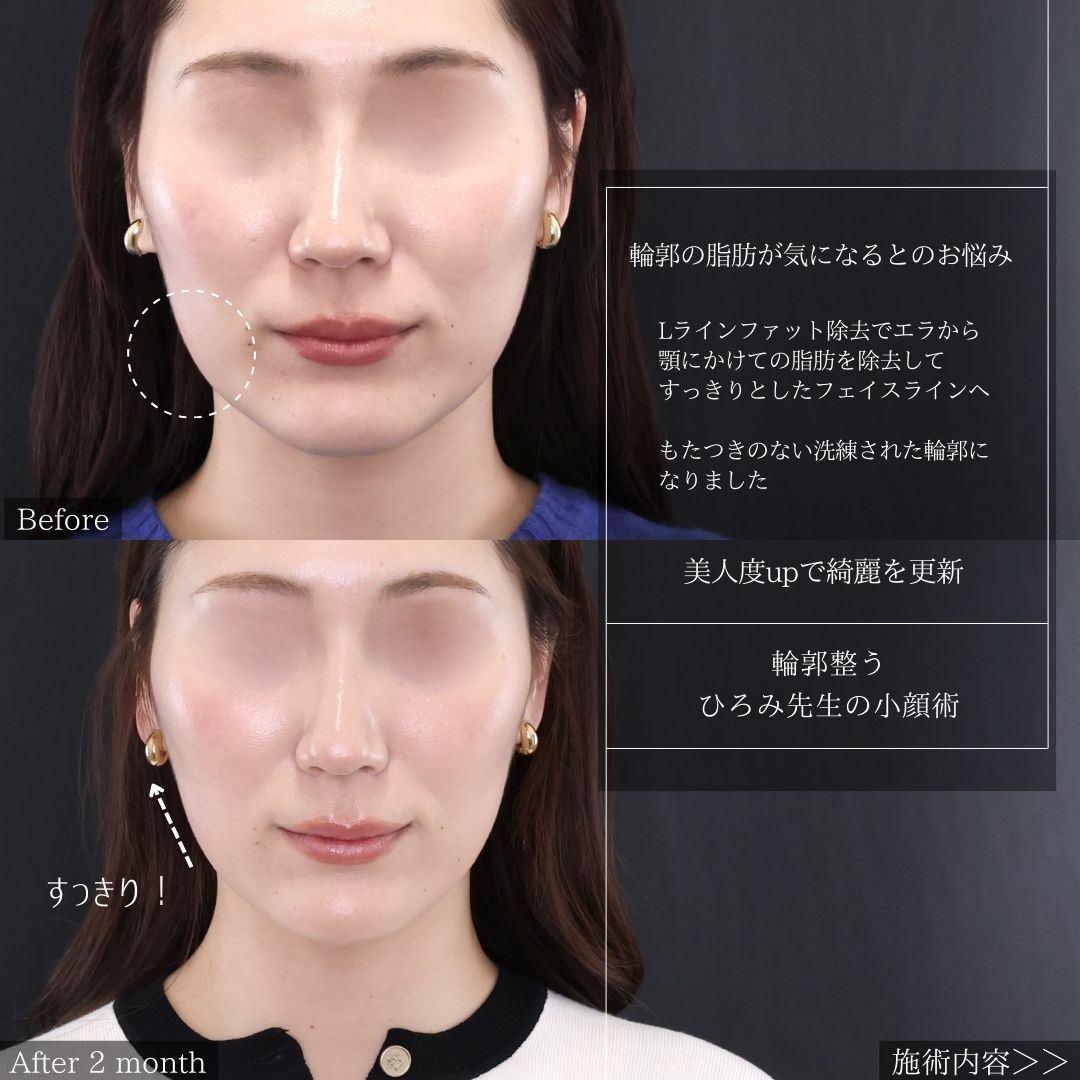 TAC式 ツヤ肌コラーゲンリフト®/Lラインファット除去(エラ下脂肪除去)/エラボトックス注射の症例写真 施術前後